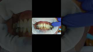 40 micron clearance and 80 micron resistance test for bilateral first molar implant crown GCam [upl. by Sexton439]