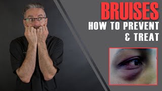 Lets Tackle Your PostTreatment Bruising [upl. by Anairo]