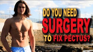 DO YOU NEED SURGERY TO FIX PECTUS EXCAVATUM [upl. by Zackariah]