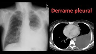 Derrame pleural [upl. by Eleinad614]