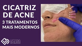 CICATRIZ DE ACNE  3 tratamentos mais MODERNOS [upl. by Kayle]