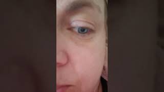 Watch My Eye Flutter amp Spasm from Dystonia [upl. by Nunciata]