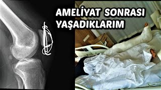 Patella Kırılması  Yaşadıklarım  diz kapağı kırılması [upl. by Wiley572]