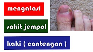 CARA MENGATASI SAKIT JEMPOL KAKI  CANTENGAN [upl. by Bartie86]