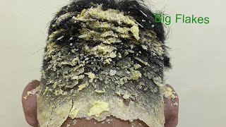 DRY SCALP  Big Flakes Dandruff Scratching Satisfying Video 768 [upl. by Stroud241]