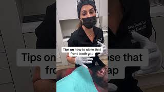 Front tooth gap  How to close it Dentist suggestion bead🦷 repaircheapsavemoneyfillfixtooth [upl. by Eedissac]