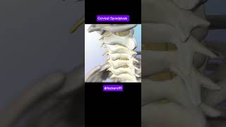 Understanding Cervical Spondylosis Symptoms and Causes [upl. by Eizzo]