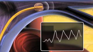 SwanGanz Thermodilution Pulmonary Artery Catheter [upl. by Varick254]
