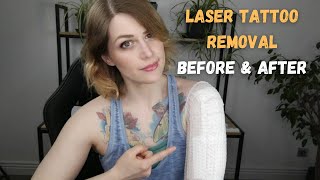 Laser Tattoo Removal Before amp After [upl. by Eibo]