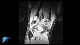 How to Read an MRI of a PCL Tear  PCL Injury Treatment Options  Sports Medicine  Twin Cities MN [upl. by Jonati]