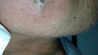 Hard recurring pimple on right cheek [upl. by Elleira]