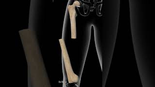 4 Most Painful Femur Shaft Fractures [upl. by Wack]