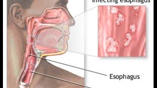 Candida Esophagitis [upl. by Eustazio]