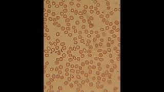 Red blood cells show anisochromia and anisocytosis [upl. by Kalle180]