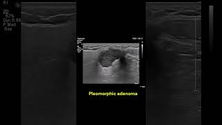 Parotid gland mass 1 imaging ultrasound radiology salivaryglands cases [upl. by Atinehc]