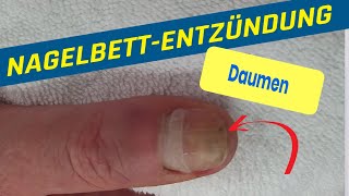 Nagelbettentzündung am Daumen durch NAGELKAUEN oder REISSEN [upl. by Dorinda630]