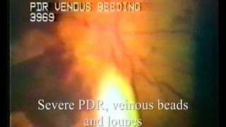 VideoDocumentation of Retinal Diseases [upl. by Anelec]