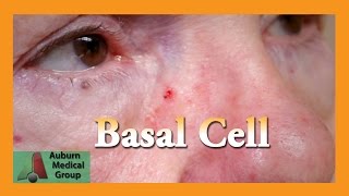 EXCISION OF BASAL CELL CARCINOMA  DR TANVEER JANJUA  NEW JERSEY [upl. by Adalie]