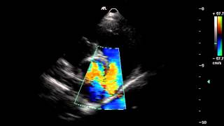 Colour Doppler Echocardiography [upl. by Nedyaj]