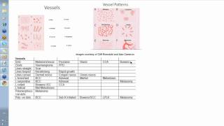 Dermoscopy Made Simple  Vessels [upl. by Eelana]