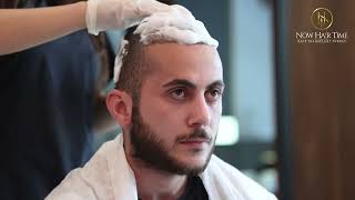 How To Remove The Scabs After Hair Transplant 2023  Now Hair Time [upl. by Raines]