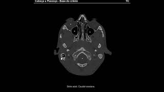 Tomografia Anatomia da Base do Crânio [upl. by Ahaelam488]