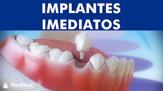 Implantes imediatos após a extração do dente © [upl. by Joyann]