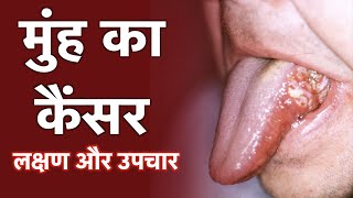 Mouth Cancer Hindi  1mg [upl. by Seaman873]