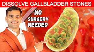 No Surgery Needed  Dissolve Gallbladder Stone  Dr Vivek Joshi [upl. by Natka]