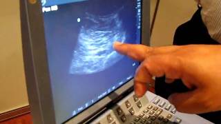 Basics of ultrasound guided regional anesthesia part IAVI [upl. by Nohsyt]