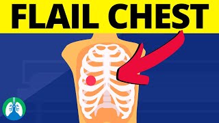 Flail Chest Medical Definition  Chest Trauma [upl. by Sergu]