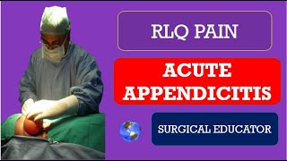 ACUTE APPENDICITIS How To DIAGNOSE amp TREAT  RLQ PAIN [upl. by Haron]