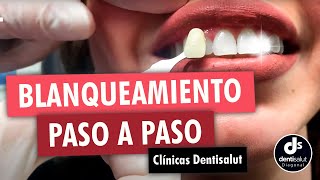 🦷😁 Blanqueamiento dental PASO A PASO 😁🦷 Antes y después  Clínica Dental Dentisalut [upl. by Potts]