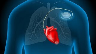 Placement of a pacemaker on the patients ♥ [upl. by Harriette925]