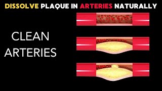 How to Dissolve Plaque in Arteries Naturally [upl. by Einamrej]