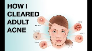 WHERE HAVE YOU BEEN Aka HOW I CLEARED MY ADULT ACNE [upl. by Nnaillek]