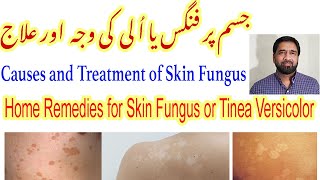 Fungal Skin Infection  Fungal Infection  Tinea Versicolor Treatment  Skin Fungus Yeast Infection [upl. by Yalonda]