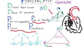 Pericarditis Tamponade physical findings [upl. by Vinita456]