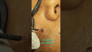 Mole Removal by Radio Frequency Ablation [upl. by Hemetaf]