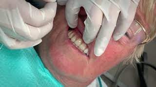 How flossing ALLON4 implants works [upl. by Pearman883]