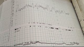 Maîtriser l’analyse du rythme cardiaque foetal [upl. by Verdha]