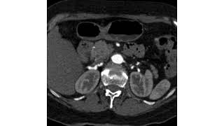 Fibromuscular Dysplasia [upl. by Heriberto]