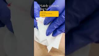 How to cure Folliculitis and its cure [upl. by Nail]