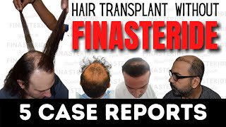 Hair transplant without Finasteride 5 Case Studies  Darling Buds Clinic [upl. by Glenine67]