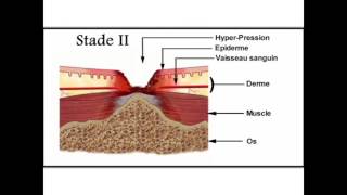 Soins des escarres en gériatrie  2Physiopathologie de lescarre [upl. by Ahseekat]