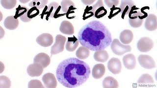 Döhle Bodies present on peripheral blood smear Hematopathology amp Hematology [upl. by Yffub]