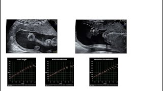 Genomics in Fetal Medicine Past Present and Future Perspectives [upl. by Taffy]