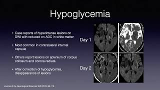 Dr Valesky Approach to Stroke Code [upl. by Hobard]