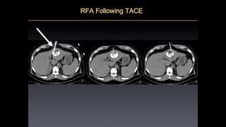 UCSF Radiology Killing Cancer Tumors w Radiofrequency Ablation Therapy [upl. by Emirac799]