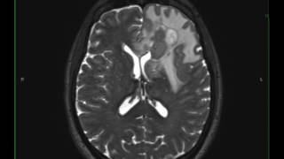 Grade 3 Anaplastic Astrocytoma [upl. by Aisenet]